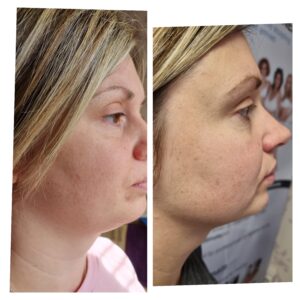 Fat Dissolving Injection(2)