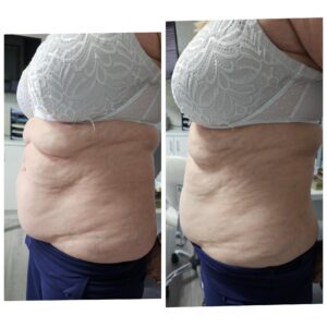 HIFU Body Sculpting(1)