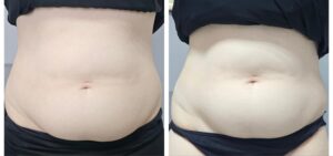 HIFU Body Sculpting(2)
