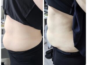 HIFU Body Sculpting(3)