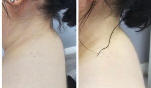 HIFU Fat Collection Treatment