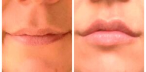 Lip Filler