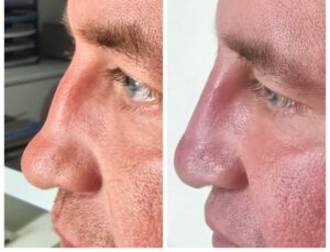 Non Surgical Rhinoplasty