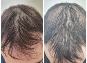 PRP Hair Restoration
