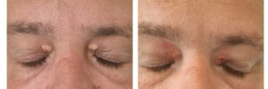 Xanthelasma Treatment